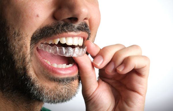 Benefits Of Choosing Clear Aligners