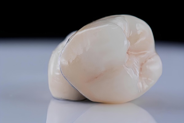 How Dental Crowns Are Used With Dental Fillings