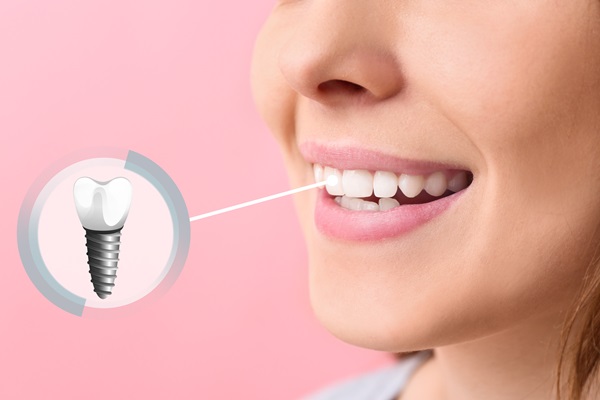 Dental Implant To Replace Single Missing Tooth