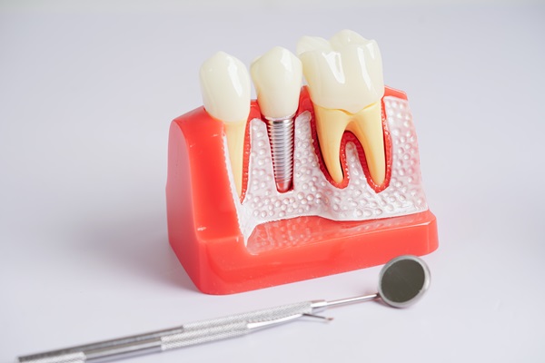 Foods You Should Avoid With Dental Implants