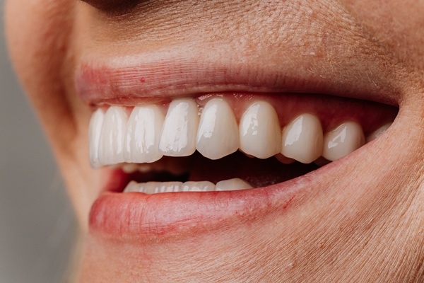 Common Dental Veneer Myths, Debunked