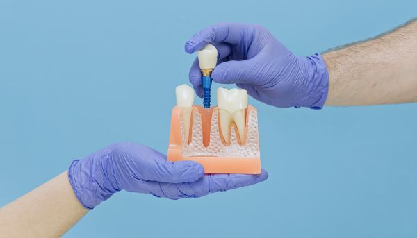 Implant Crowns: The Key To Restoring Missing Teeth